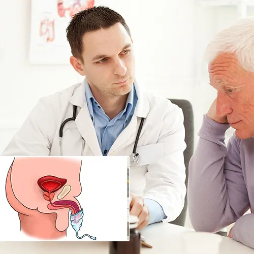 The Journey to Choosing a Malleable Penile Implant with  Urological Consultants of Florida 
